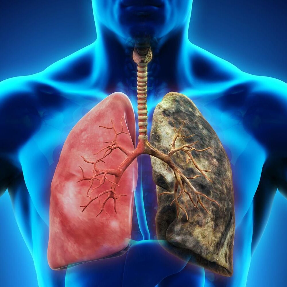 rakovina-plic-zdroj-Shutterstock rakovina-plic-zdroj-Shutterstock